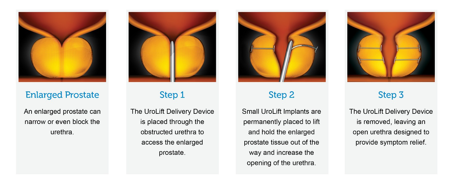 UroLift System | South Central Regional Medical Center